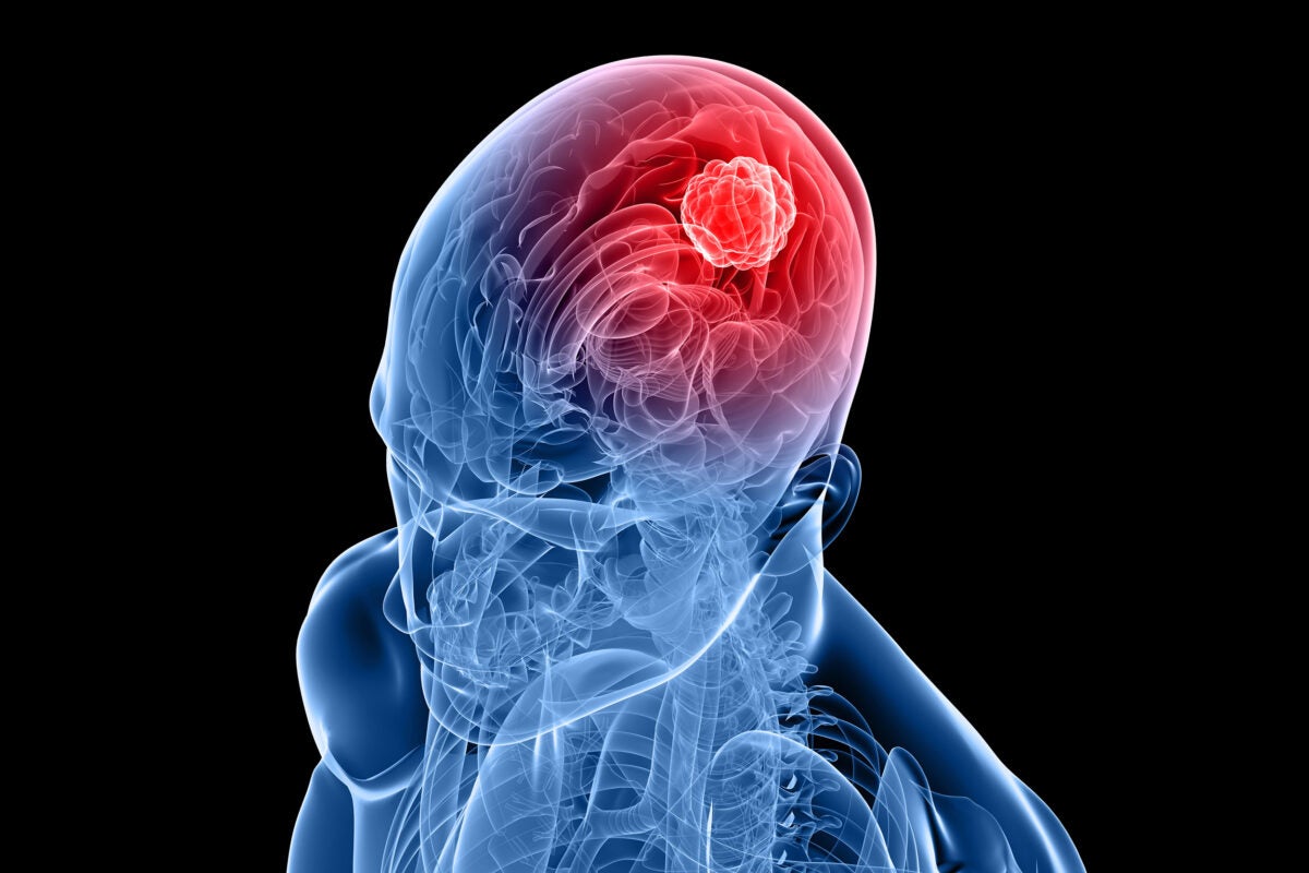 Breakthrough blood test developed for brain tumors